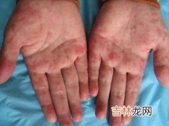 系统性红斑狼疮伴桥本甲状腺炎与格林-巴利综合征一例