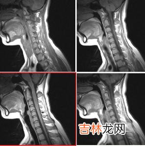 视神经挫伤的临床表现有哪些