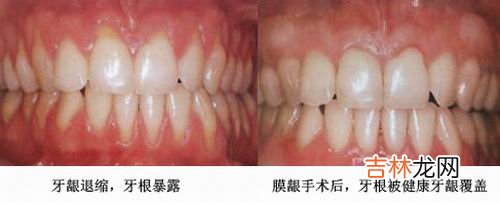 膜龈手术都有哪些