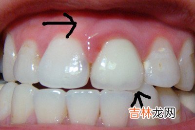 怎样维持牙周治疗的疗效