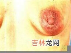 面部乳房外湿疹样癌一例