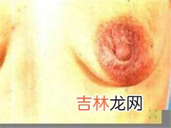 面部乳房外湿疹样癌一例