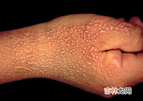 伊曲康唑治疗花斑癣临床实验总结