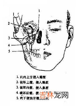 上颌窦恶性肿瘤的临床表现是什么