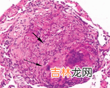 鼻腔恶性肿瘤的临床表现是什么