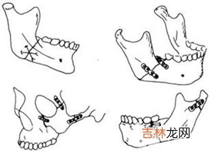 颌骨颌骨骨折骨折的复位和固定方法有哪些