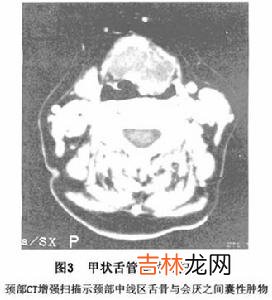 甲状舌管囊肿有什么临床表现