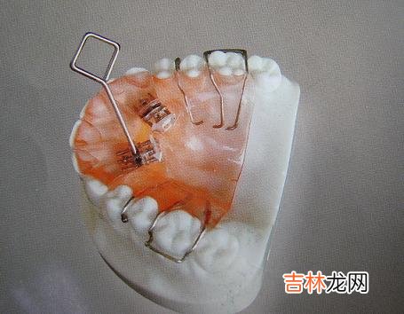 什么是活动矫治器