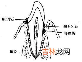 牙周袋是怎样形成的它有什么样的表现