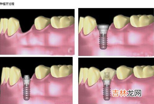 为什么全口牙咬合要平衡