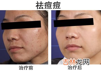 留住青春不要痘的美白方法