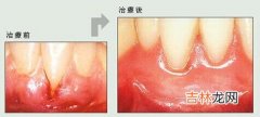 治疗牙病新方法以激光取代牙钻