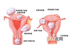 得了子宫肌瘤就会癌变吗