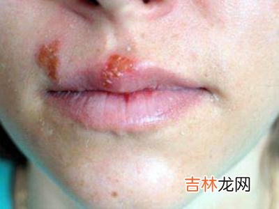 单纯疱疹病毒感染在口腔的表现是什么