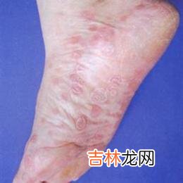 白塞病怎样治疗