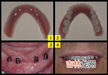 种植固定全口义齿怎样修复