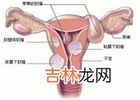 女性子宫肌瘤如何自查