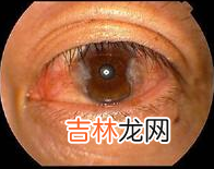 眼结石是怎么回事