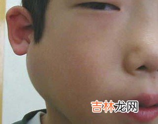 怎样治疗慢性复发性腮腺炎