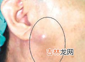 常见的涎腺肿瘤有哪些