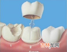 补牙材料种类细说