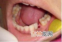 拔牙后需要注意什么