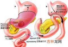 背疼或是十二指肠溃疡征兆