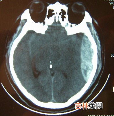 战时重型颅脑伤高级救治系统的建立与探讨