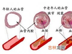 反复发作性Ⅱ度窦房阻滞致心脑血管急症4例