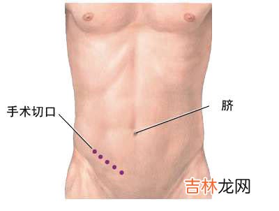 腹腔镜辅助阑尾切除术120例