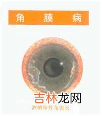 真菌性角膜炎35例
