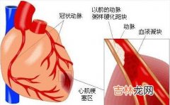 复苏后溶栓治疗急性心肌梗死猝死6例