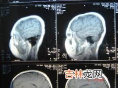 综合治疗恶性脑胶质瘤29例