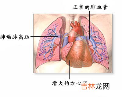 扩张型心肌病心律失常144例