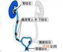 脉冲电疗仪治疗肾输尿管结石312例