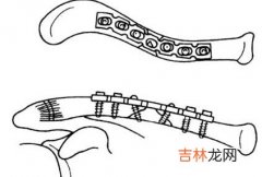 钢丝带固定治疗锁骨多段骨折9例