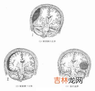 创伤性颅脑损伤后颅内低压8例