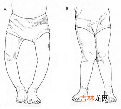 胫骨近端截骨矫治膝内翻18例