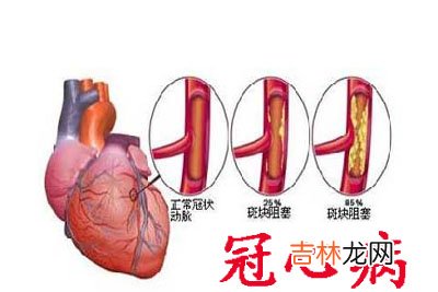 冠心病冠状动脉旁路移植术36例