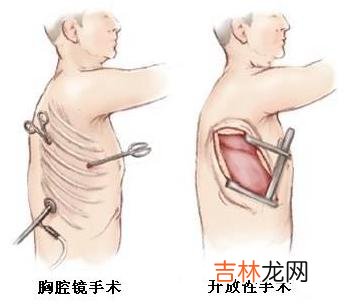 电视胸腔镜诊治胸腔出血32例