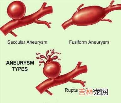 人工血管移植治疗腹主动脉瘤17例