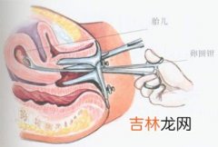 判断流产是否完全