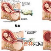 初次怀孕可以人工流产吗