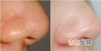 每天九分钟彻底歼灭草莓鼻