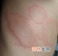 孕妇春天要防患风疹