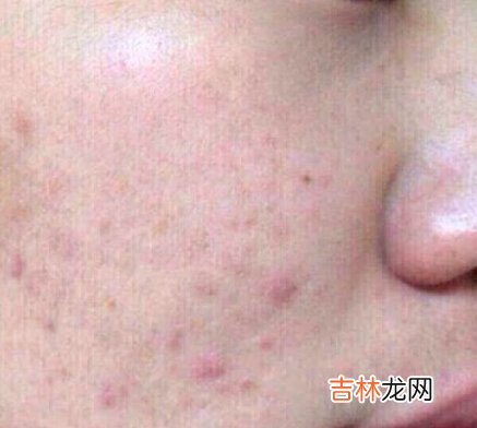 幾乎人人都會感染痘痘
