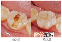 不肯每天刷3次牙抽查显示9成中年人患龋齿