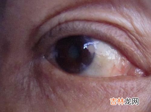 高强度紫外线会导致白内障的发生