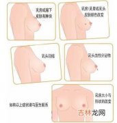 女教师女白领女企业家成为乳腺癌高发人群