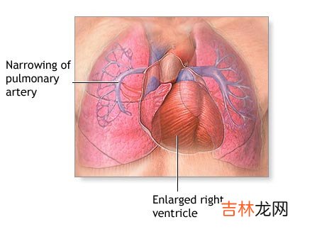 肺动脉高压成年轻人杀手发病不高误诊高